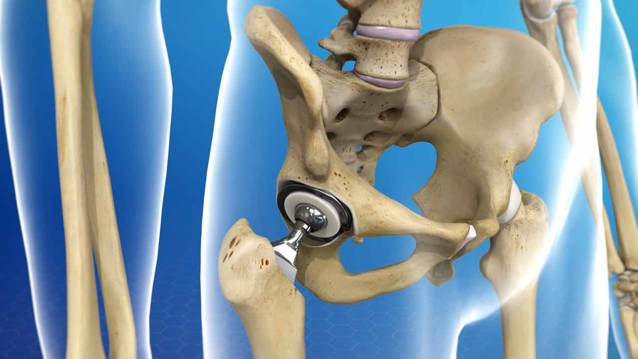 Hip Replacement Surgery 
